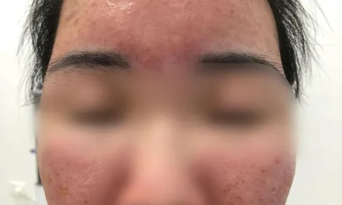 Hỏng da vì dùng kem "SPF 70 siêu chống nắng" mua trên mạng