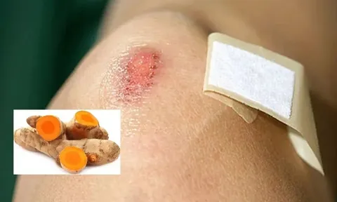 Dùng nghệ tươi trị sẹo có tốt không?