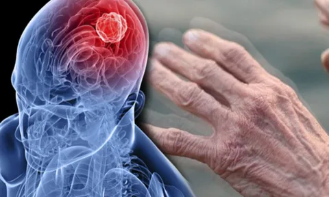 Nam và nữ mắc Parkinson biểu hiện sớm khác nhau ra sao?