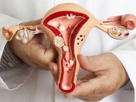 Dấu hiệu nhận biết mắc bệnh ung thư phụ khoa