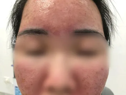 Hỏng da vì dùng kem "SPF 70 siêu chống nắng" mua trên mạng
