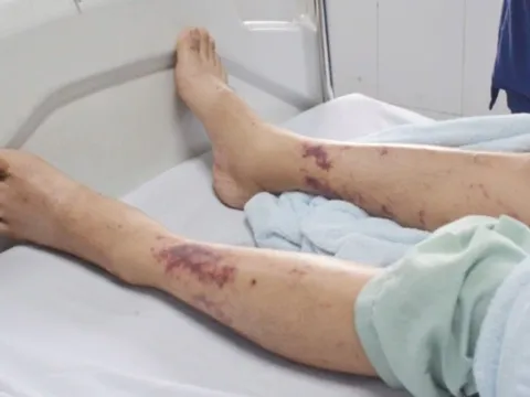 Số ca mắc liên cầu lợn tăng bất thường, cần làm gì để phòng tránh?