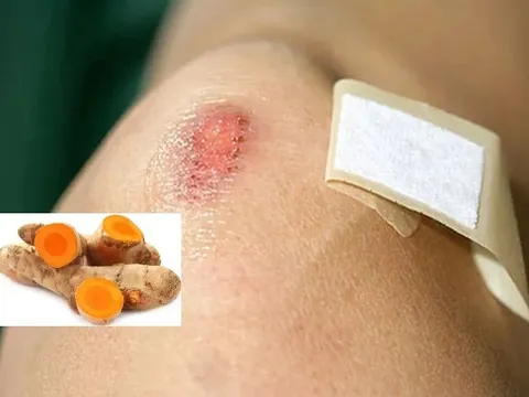 Dùng nghệ tươi trị sẹo có tốt không?