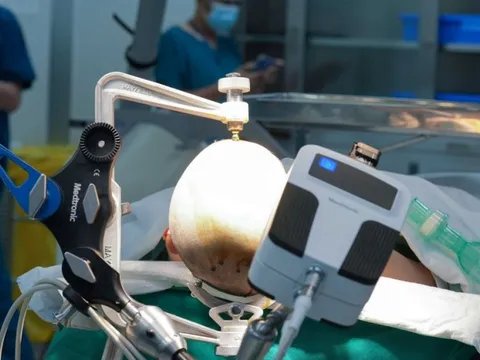 Vinmec tiên phong điều trị động kinh bằng Robot định vị thần kinh hàng đầu thế giới