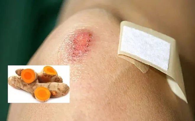 Dùng nghệ tươi trị sẹo có tốt không?