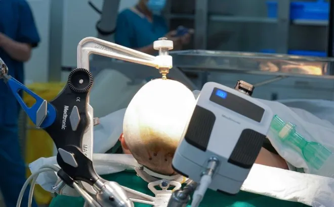 Vinmec tiên phong điều trị động kinh bằng Robot định vị thần kinh hàng đầu thế giới