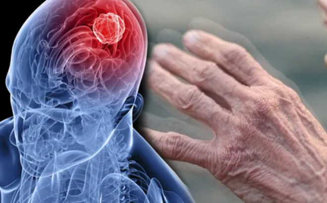 Nam và nữ mắc Parkinson biểu hiện sớm khác nhau ra sao?